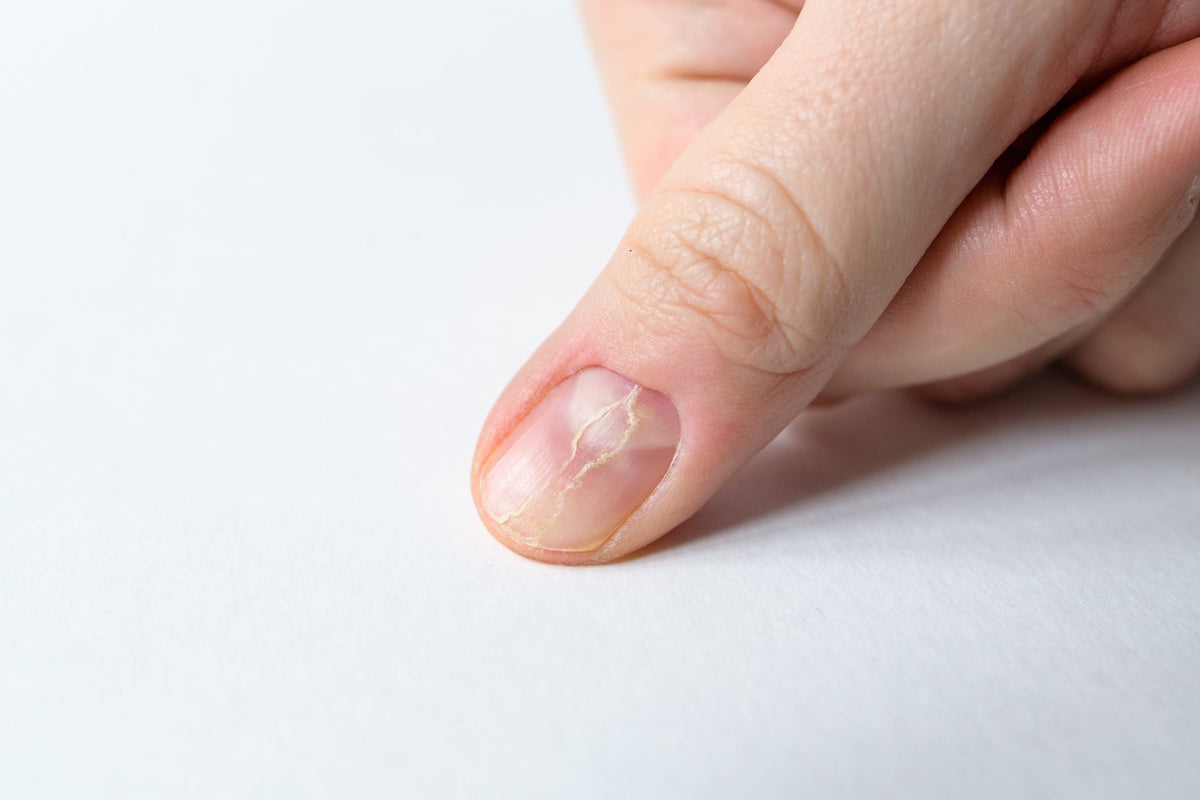 Häufige Nagelprobleme und ihre Ursachen