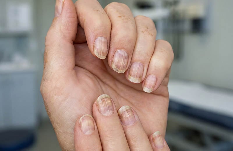 Längsrillen in den Fingernägeln: Ursachen, Bedeutung & was wirklich hilft
