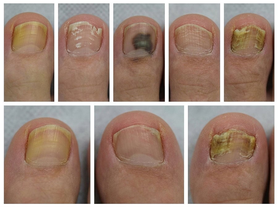 Nagelpilz oder doch nicht? Verwechslungen mit Bildern