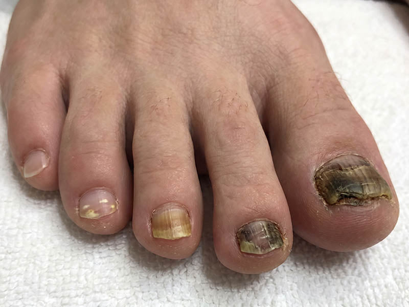 Wie sieht Nagelpilz aus? Bilder, Anfangsstadium und Verwechslungen