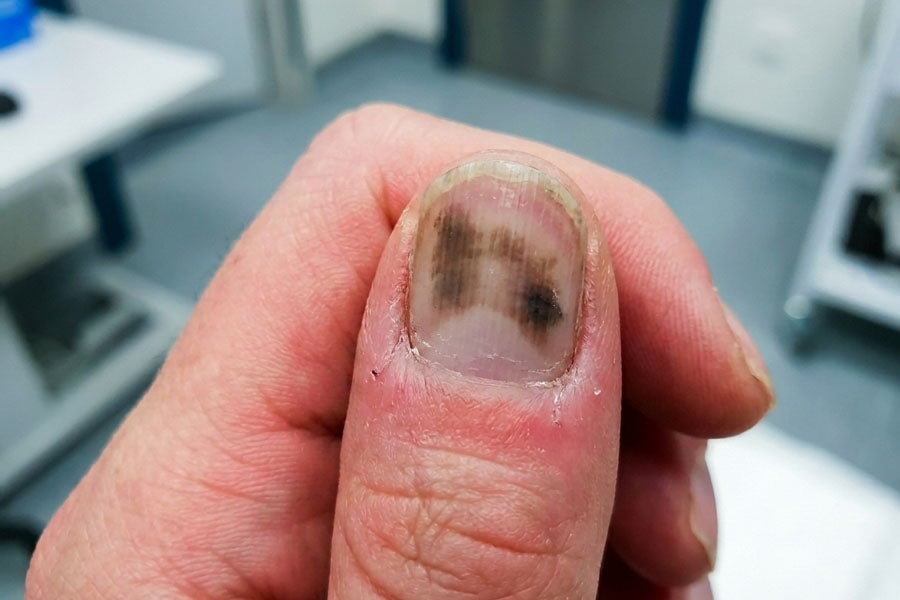 Schwarzer Nagelpilz: Wann es gefährlich wird