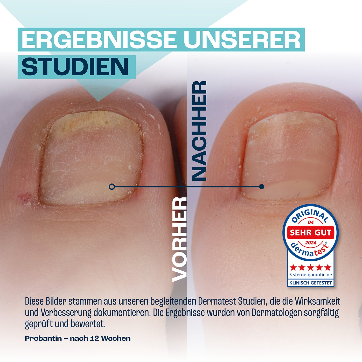 NAGELNEU Pflegendes Nagelgel 20ml