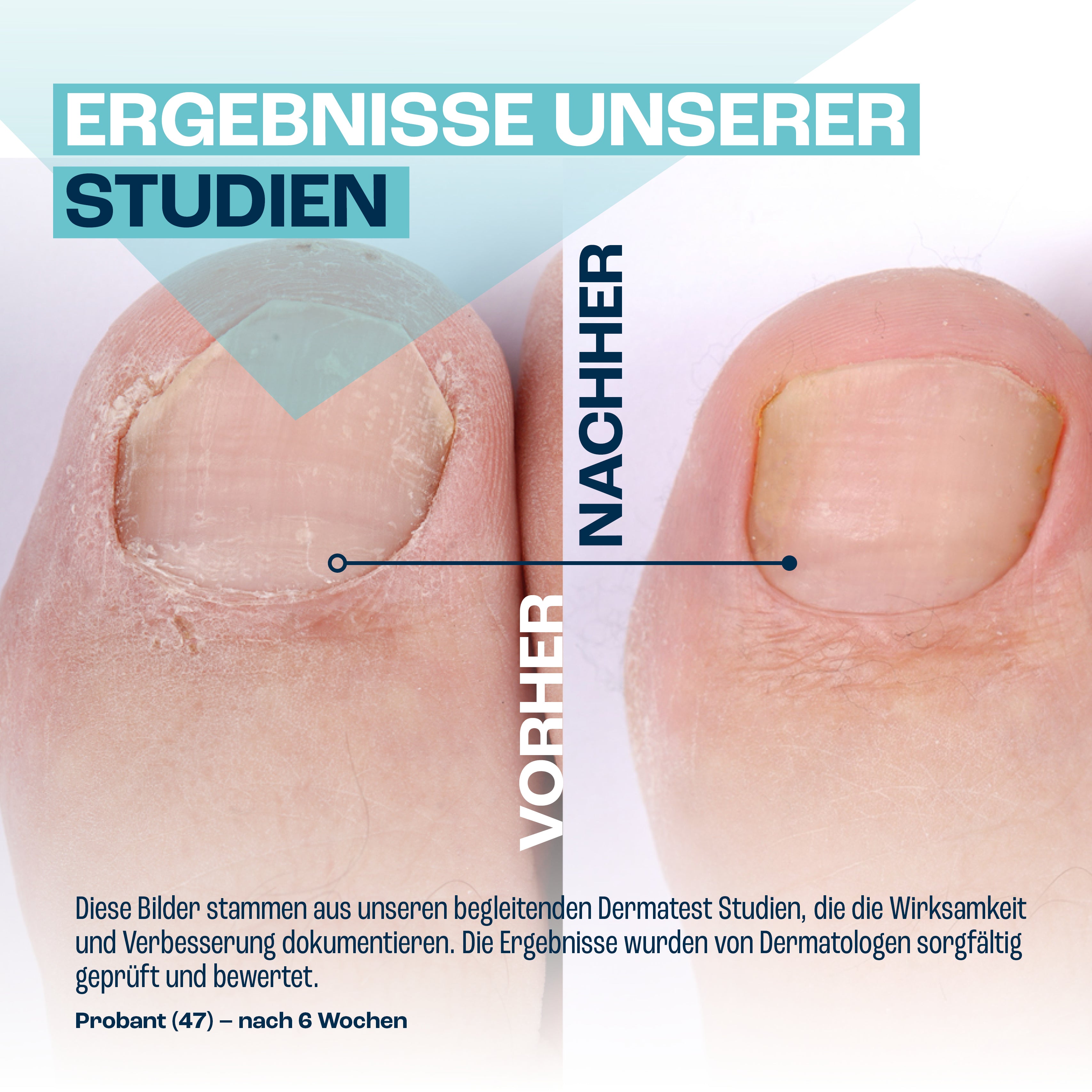 Nagelpilz Pflegeset: SORGLOS