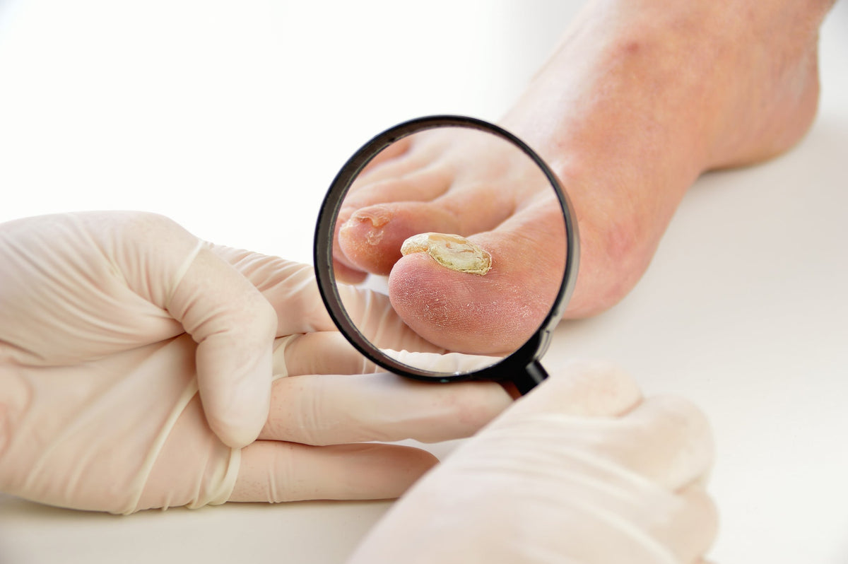Frühzeitiges Erkennen von Nagelproblemen – Anleitung zur Selbstuntersuchung