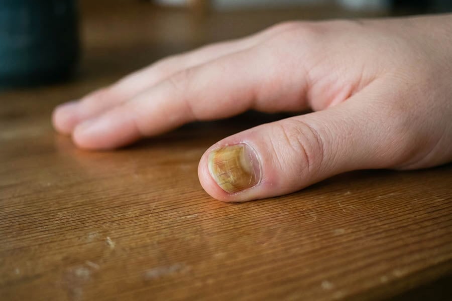 Nagelpilz am Finger: Erkennen, Pflegen, Vorbeugen