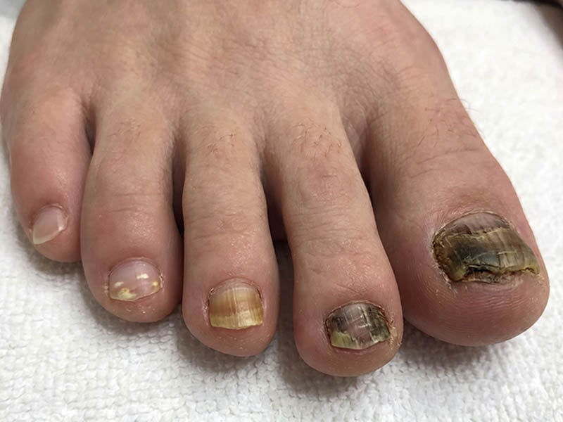 Wie sieht Nagelpilz aus? Bilder, Anfangsstadium und Verwechslungen